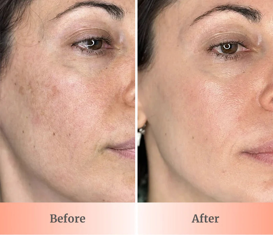 Glowup™ LED Light Therapy Face Mask